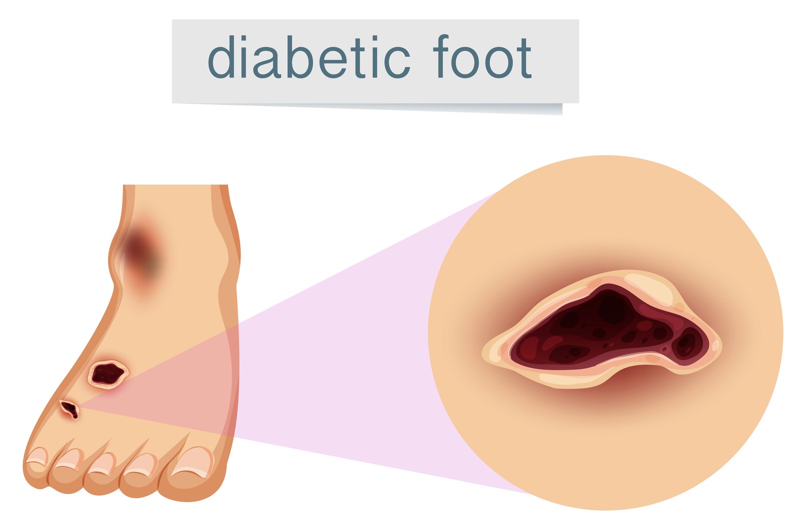 Diabetic Foot Infection Plan in Dallas: Same-Day Steps and When vs. ER