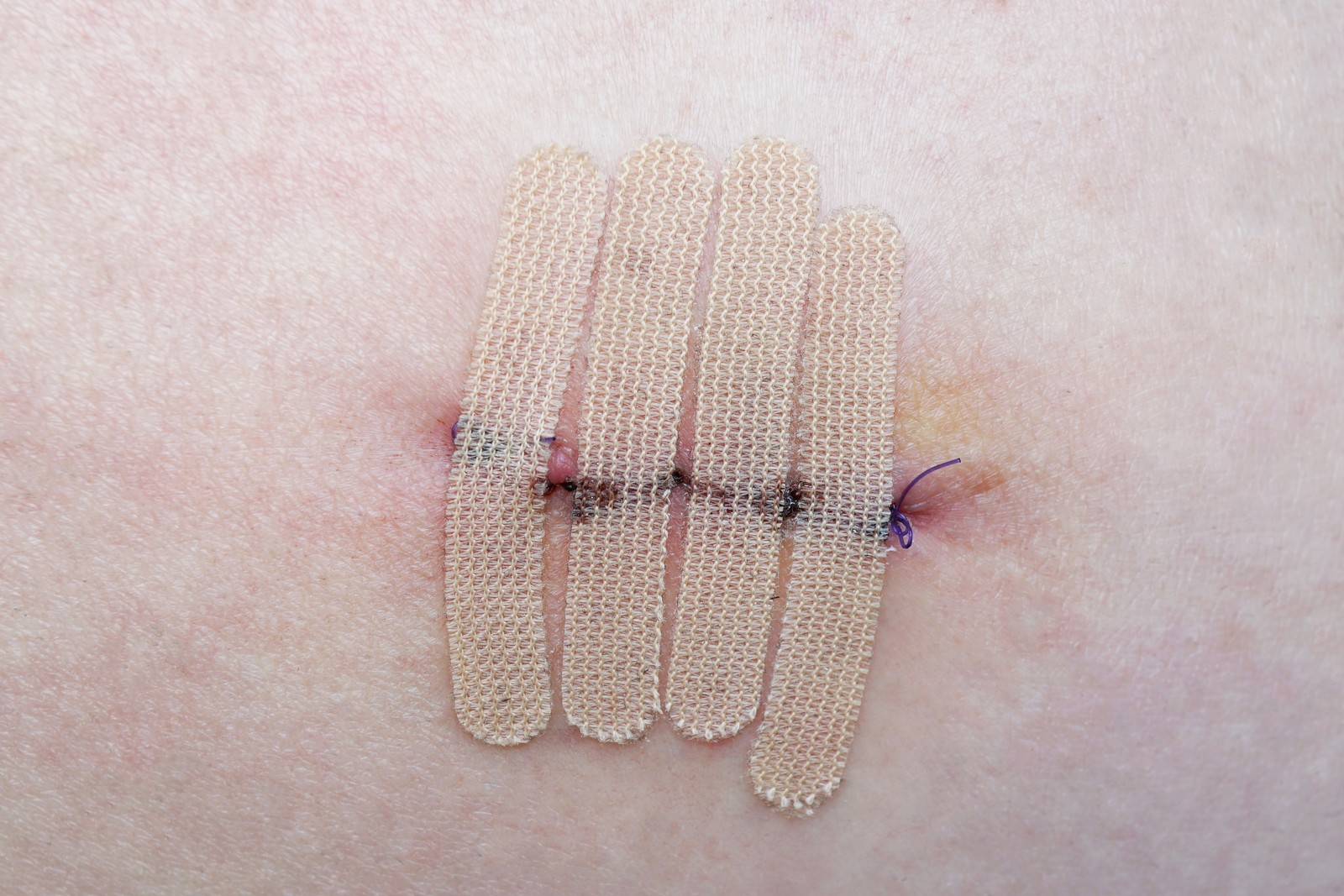 Managing Non-Healing Surgical Wounds at Home in Dallas–Fort Worth