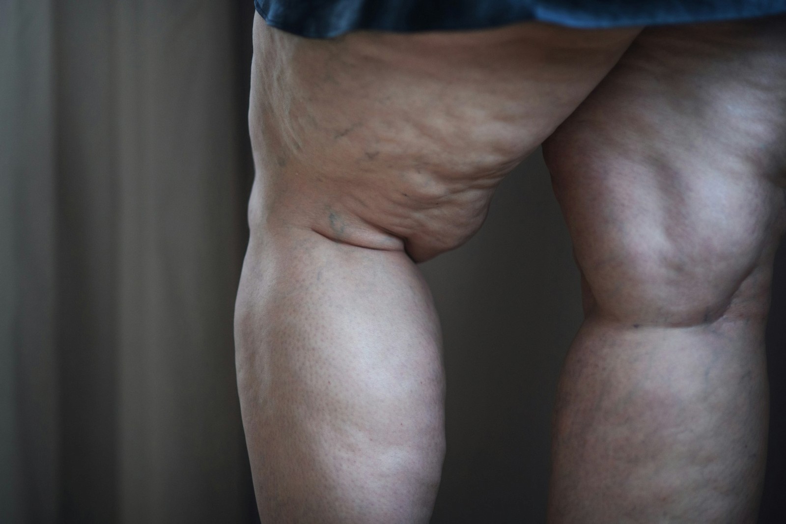 Lymphedema Therapy in Dallas, TX for Chronic Wounds Explained