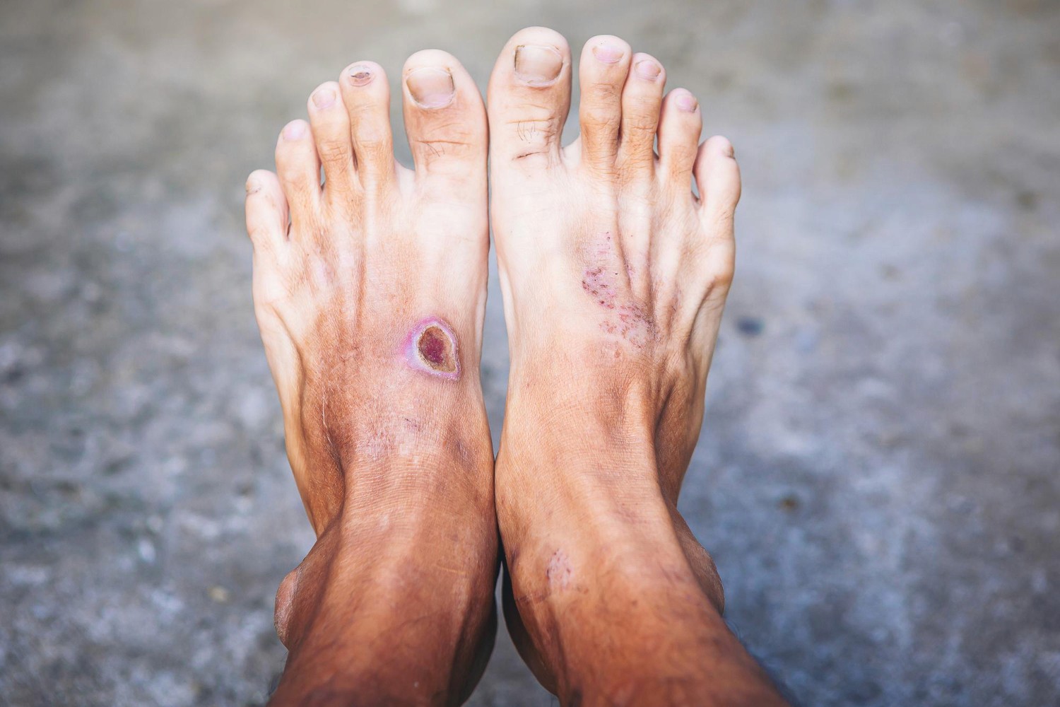 When Remote Wound Care Beats the Clinic for Dallas Patients