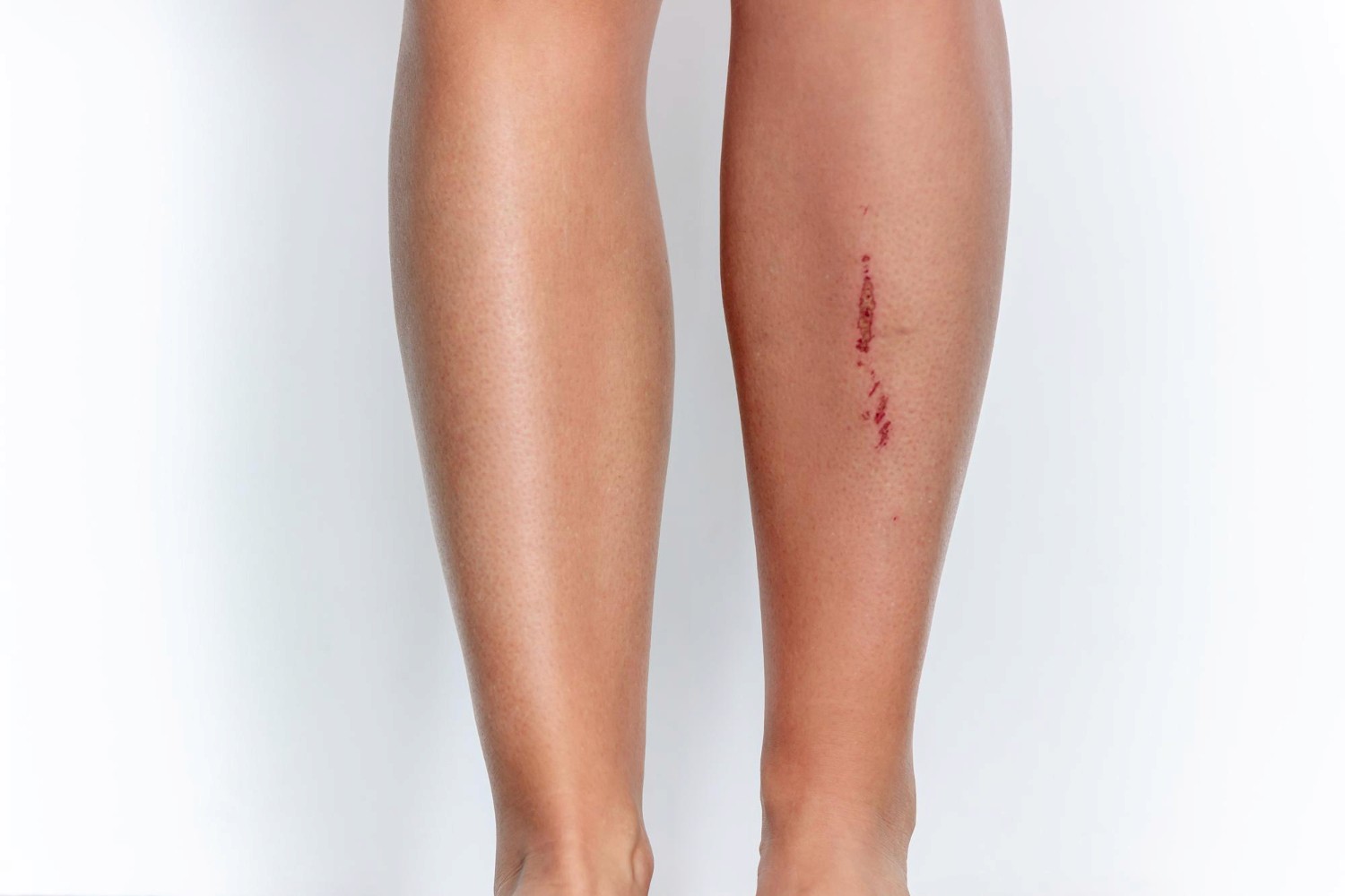 Mobile Wound Care in Dallas for Venous Leg Ulcer Relief