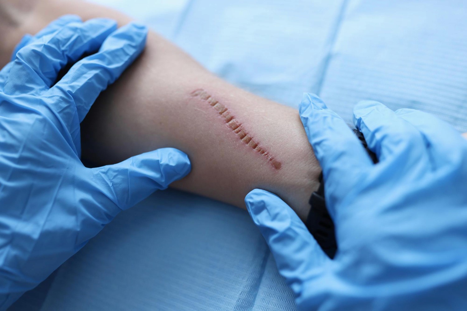 Wound Care vs. Dermatology for Post-Surgical Incisions