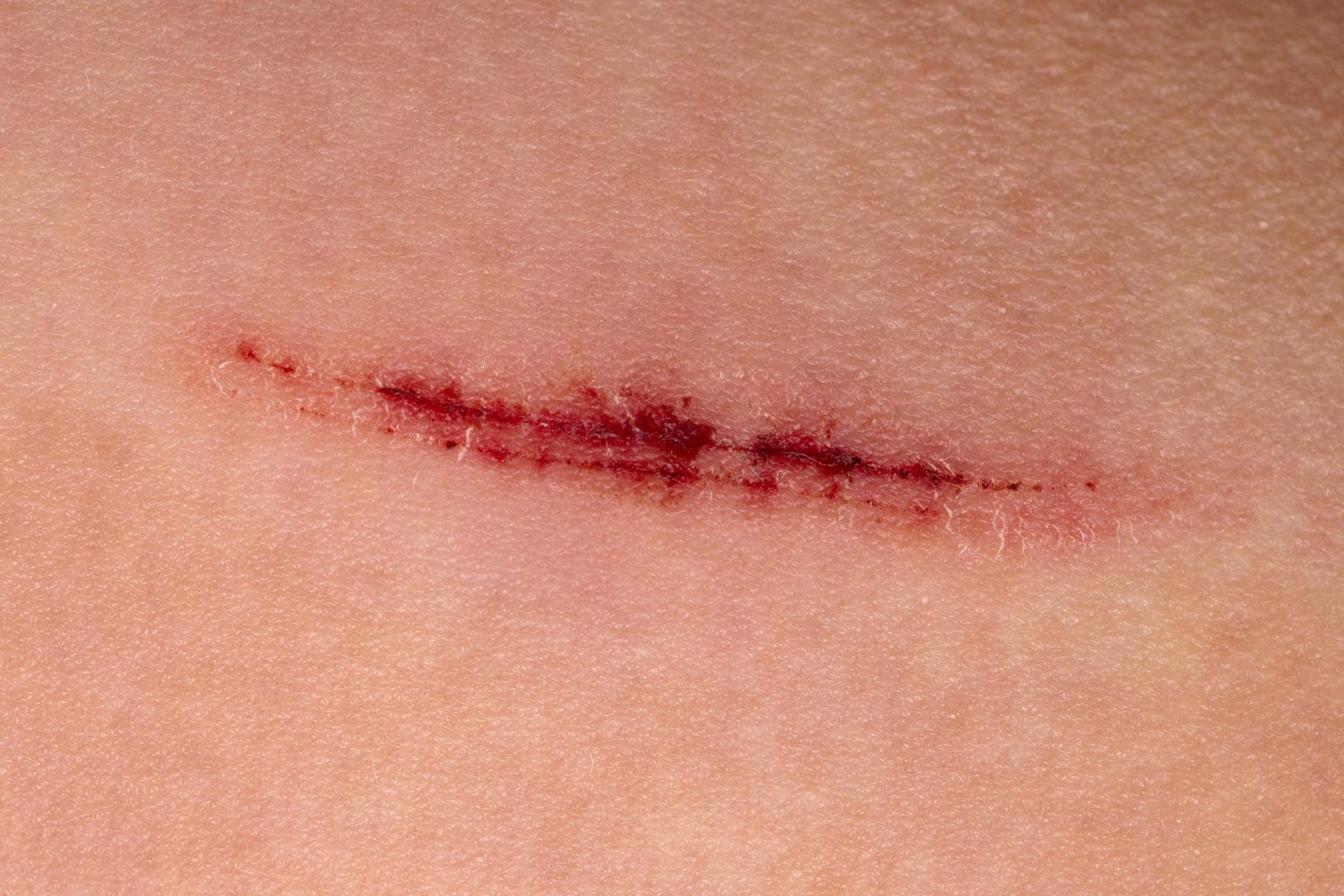 Diabetic Wound Care in Dallas: Home Nutrition and Bedside Treatment