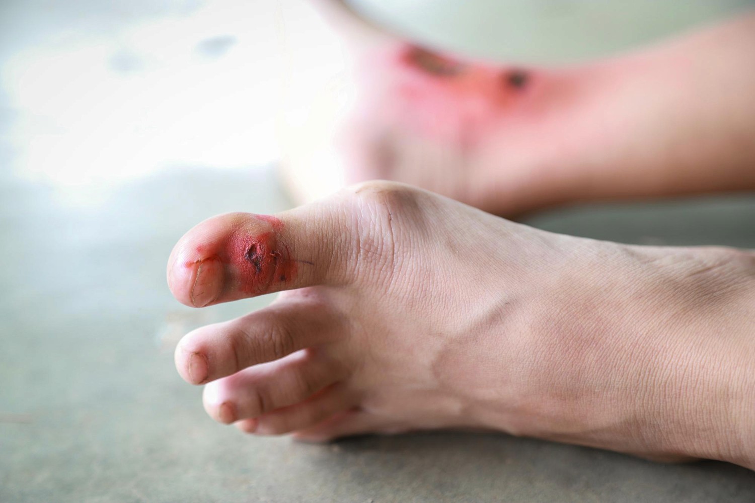 What Bedside Wound Care in Dallas TX Looks Like Week to Week