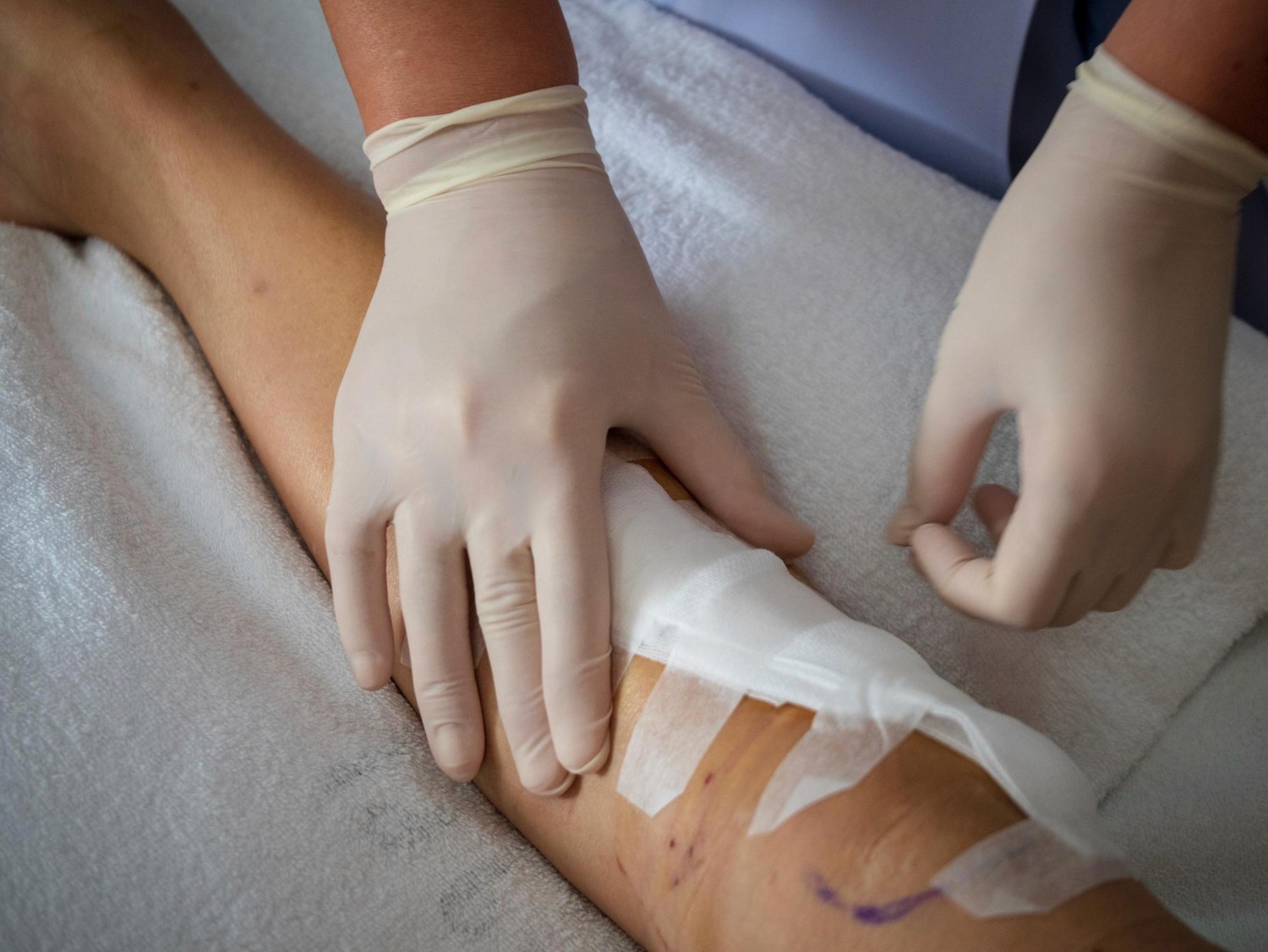 What to Expect From NPWT Wound Therapy at Home Near You