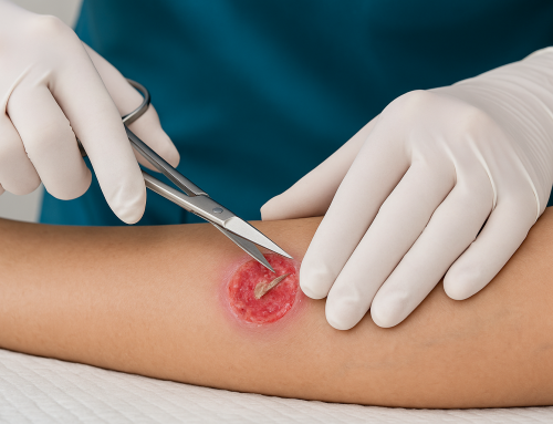 Understanding Sharp Debridement: What It Is and How It Helps Wound Healing