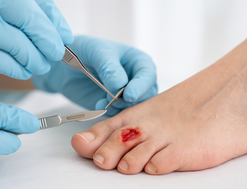 Sharp Debridement Procedure: What It Is, How It’s Done, and What to Expect